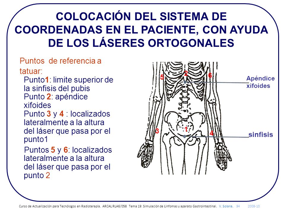 COLOCACIÓN DEL SISTEMA DE COORDENADAS EN EL PACIENTE, CON AYUDA DE LOS LÁSERES ORTOGONALES