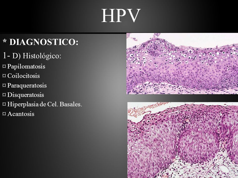 HPV * DIAGNOSTICO: 1- D) Histológico: ¤ Papilomatosis ¤ Coilocitosis