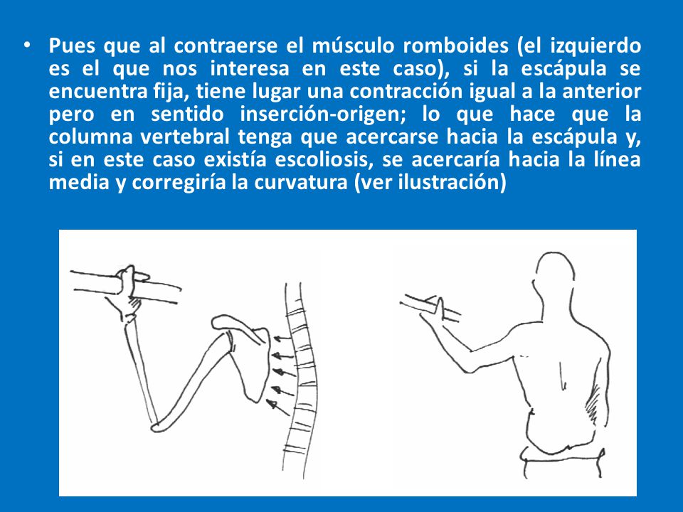 Pues que al contraerse el músculo romboides (el izquierdo es el que nos interesa en este caso), si la escápula se encuentra fija, tiene lugar una contracción igual a la anterior pero en sentido inserción-origen; lo que hace que la columna vertebral tenga que acercarse hacia la escápula y, si en este caso existía escoliosis, se acercaría hacia la línea media y corregiría la curvatura (ver ilustración)
