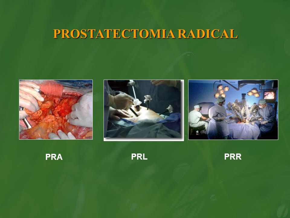 PROSTATECTOMIA RADICAL