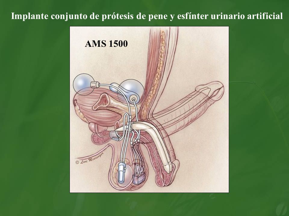 Implante conjunto de prótesis de pene y esfínter urinario artificial
