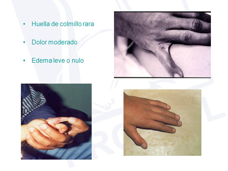 • Huella de colmillo rara • Dolor moderado • Edema leve o nulo