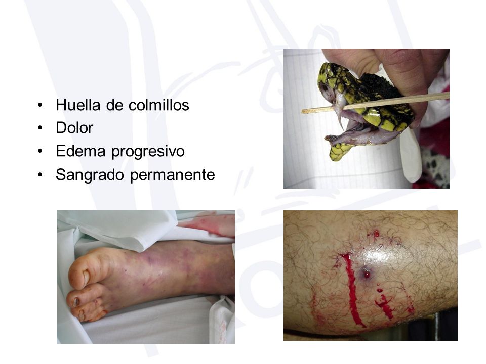 • Huella de colmillos Dolor Edema progresivo Sangrado permanente