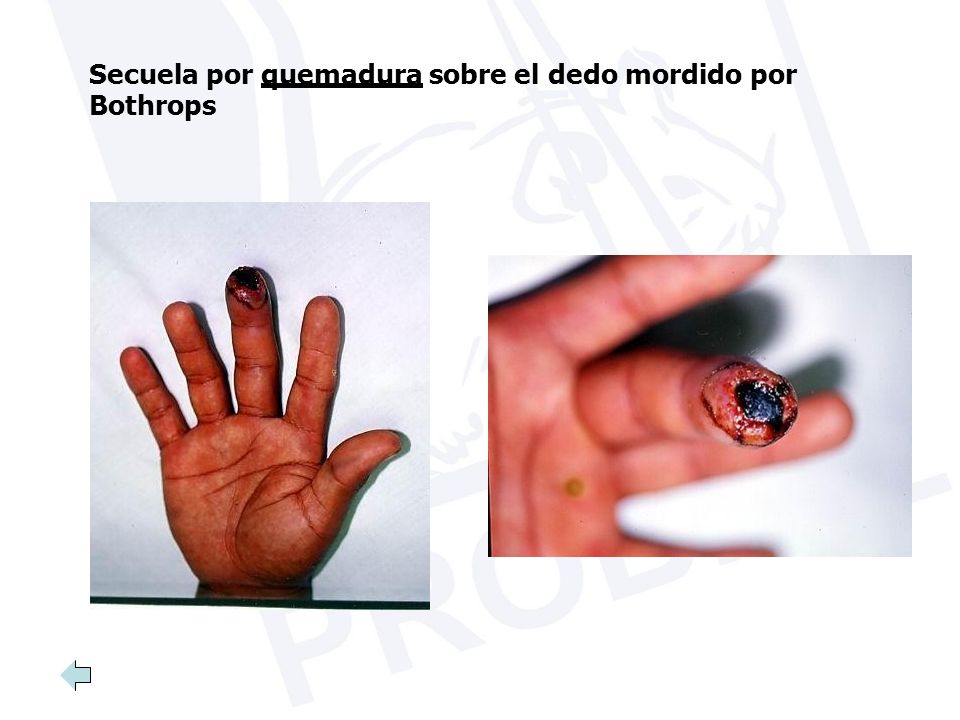 Secuela por quemadura sobre el dedo mordido por