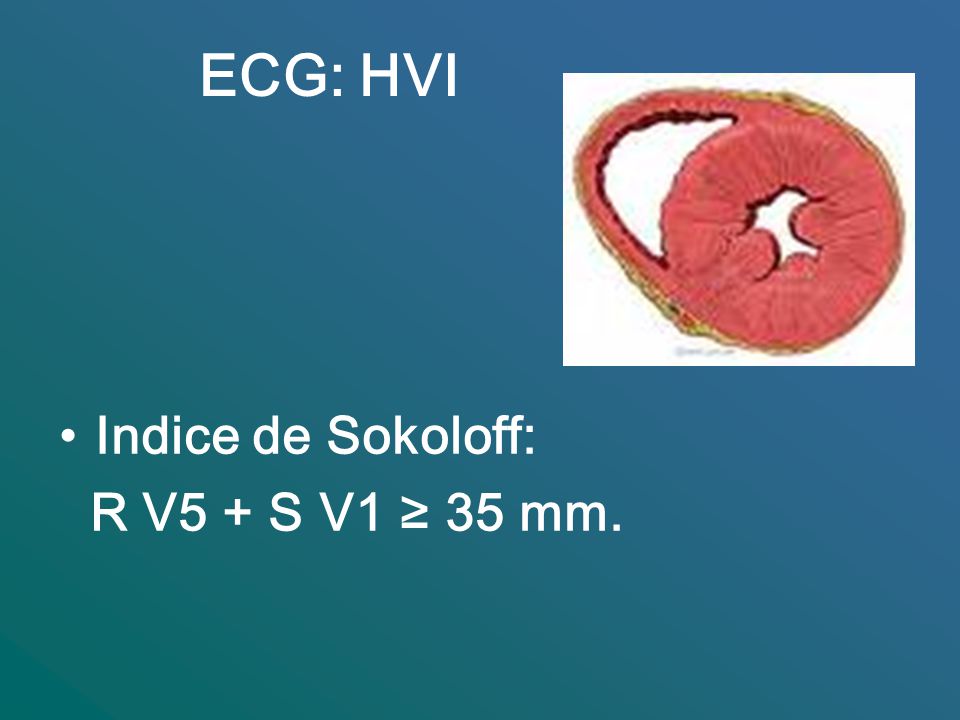 ECG: HVI Indice de Sokoloff: R V5 + S V1 ≥ 35 mm.