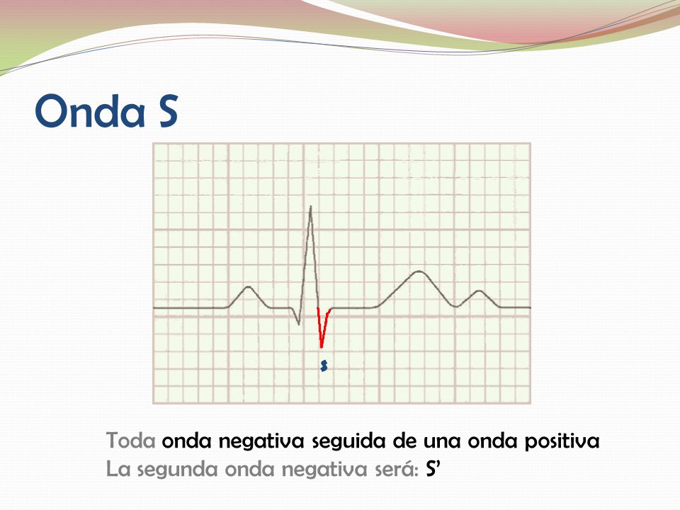 Onda S Toda onda negativa seguida de una onda positiva
