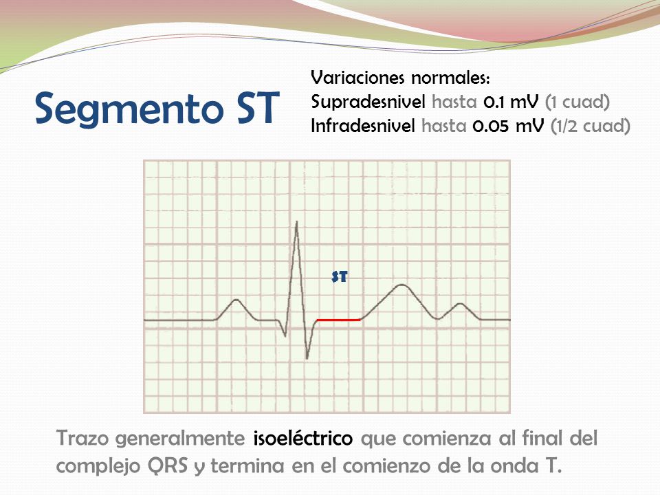Segmento ST Variaciones normales: Supradesnivel hasta 0.1 mV (1 cuad) Infradesnivel hasta 0.05 mV (1/2 cuad)