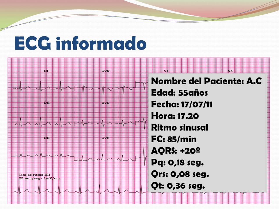 ECG informado Nombre del Paciente: A.C Edad: 55años Fecha: 17/07/11