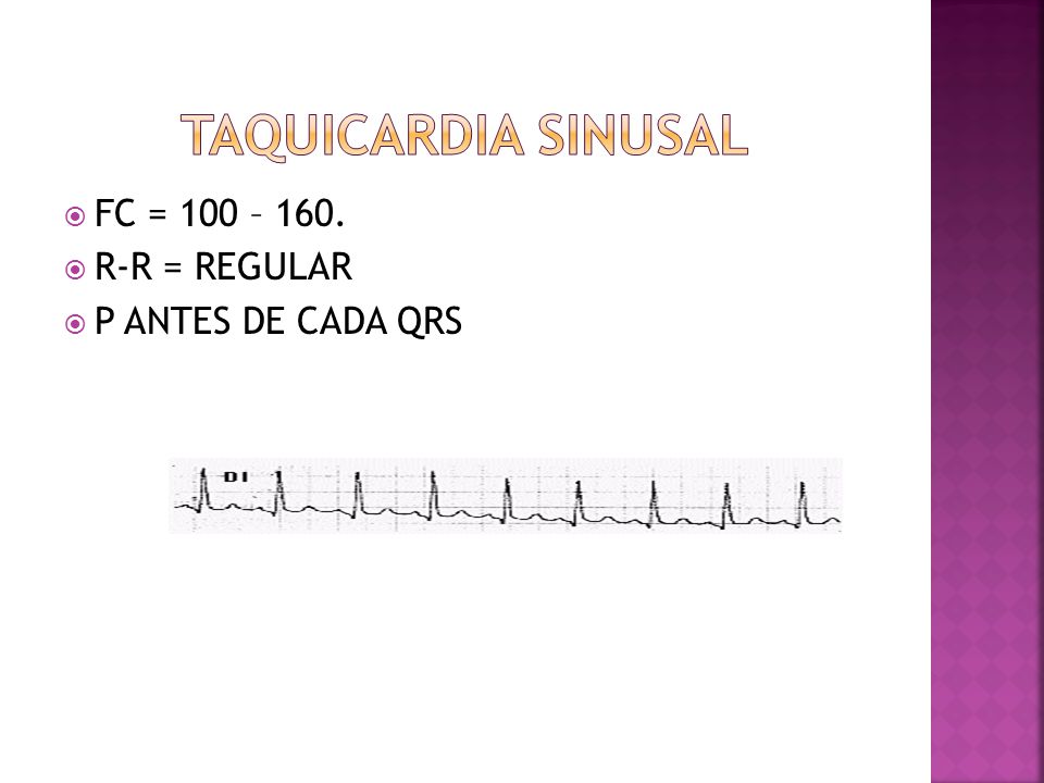 TAQUICARDIA SINUSAL FC = 100 – 160. R-R = REGULAR P ANTES DE CADA QRS