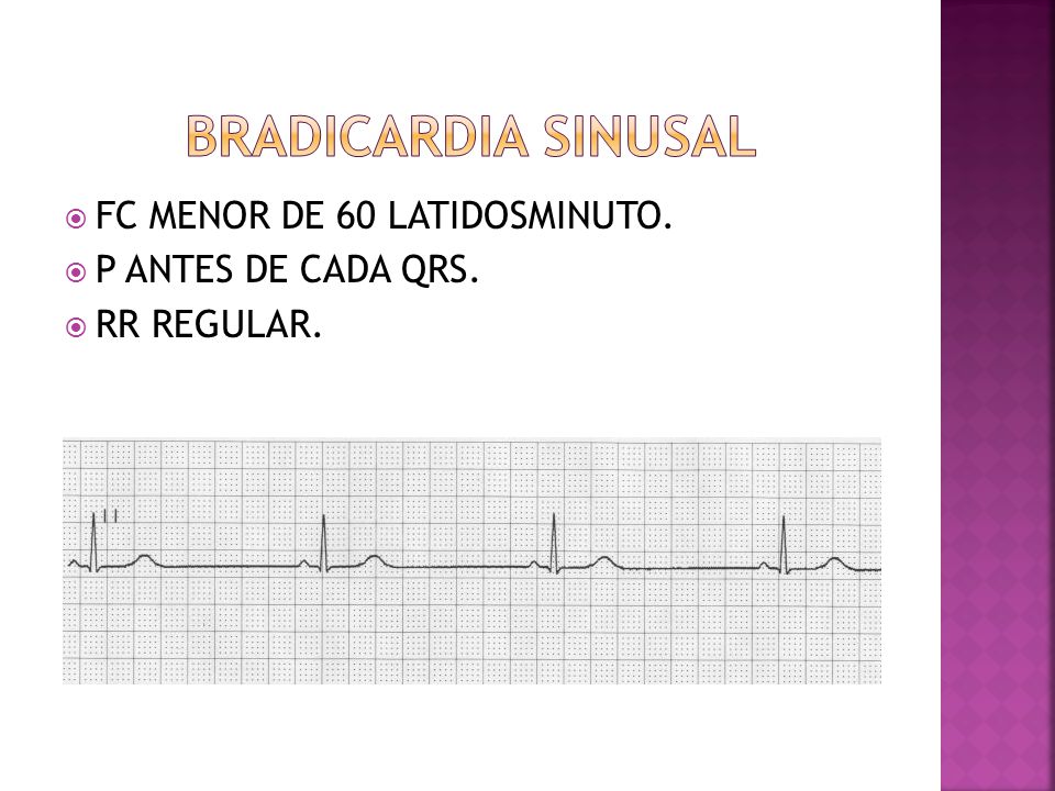 BRADICARDIA SINUSAL FC MENOR DE 60 LATIDOSMINUTO. P ANTES DE CADA QRS.