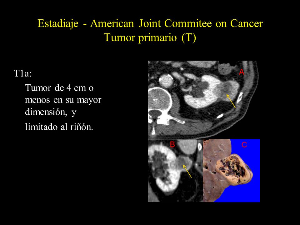 Estadiaje - American Joint Commitee on Cancer Tumor primario (T)