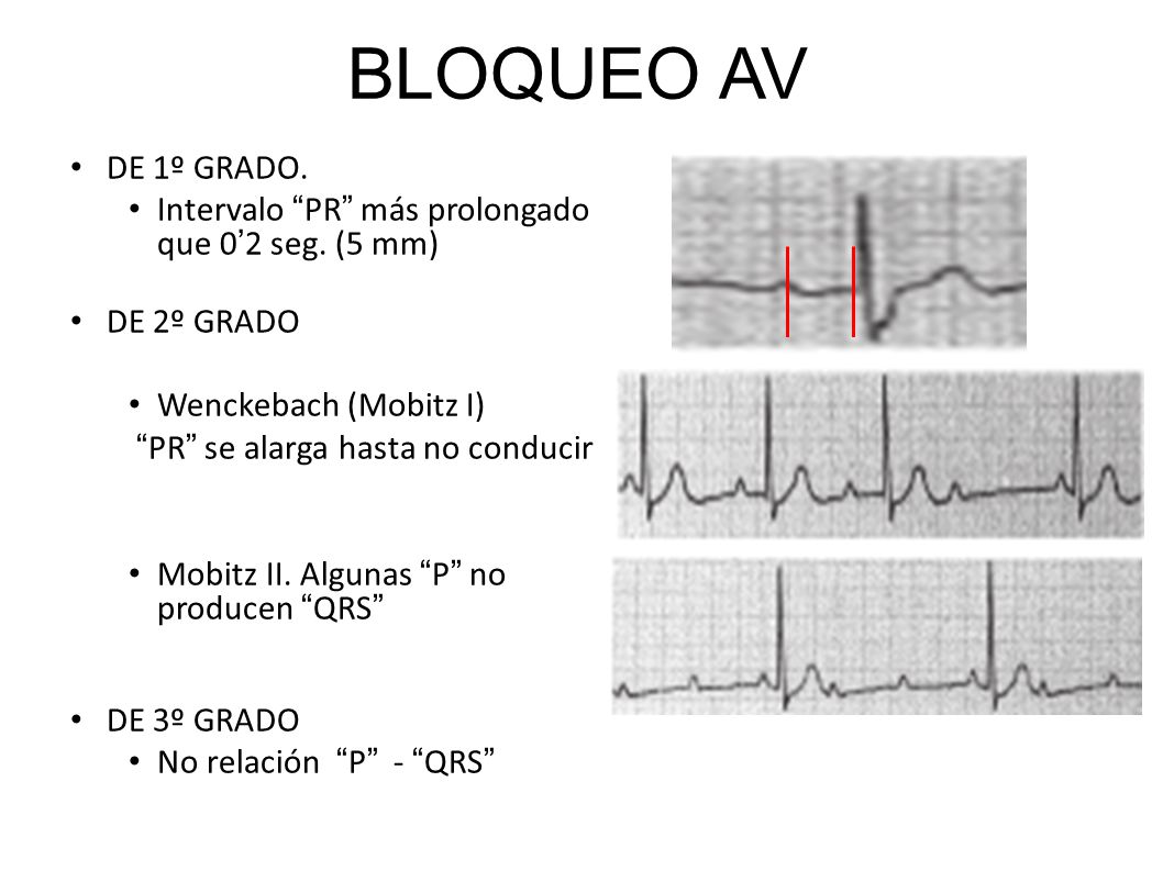 BLOQUEO AV DE 1º GRADO. Intervalo PR más prolongado que 0’2 seg. (5 mm) DE 2º GRADO. Wenckebach (Mobitz I)