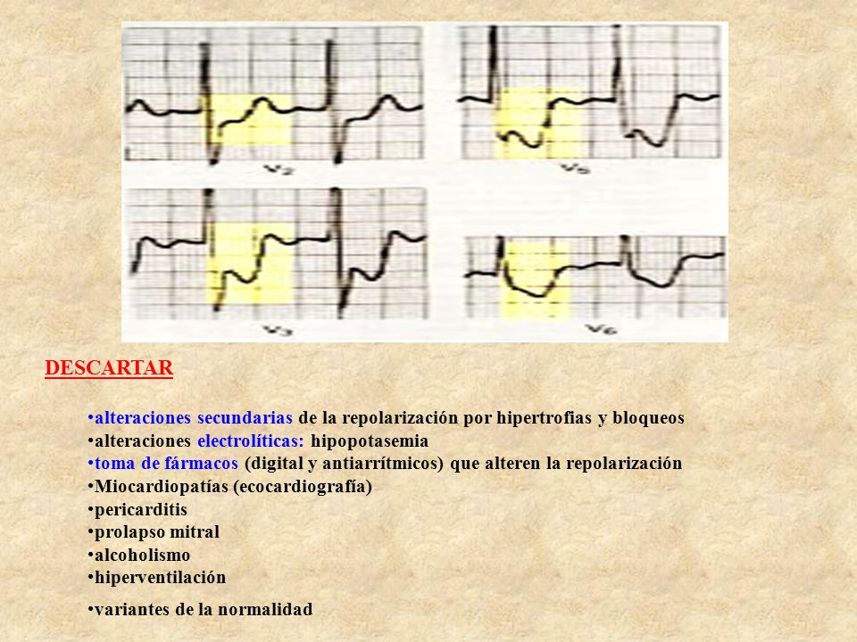 DESCARTAR alteraciones secundarias de la repolarización por hipertrofias y bloqueos. alteraciones electrolíticas: hipopotasemia.