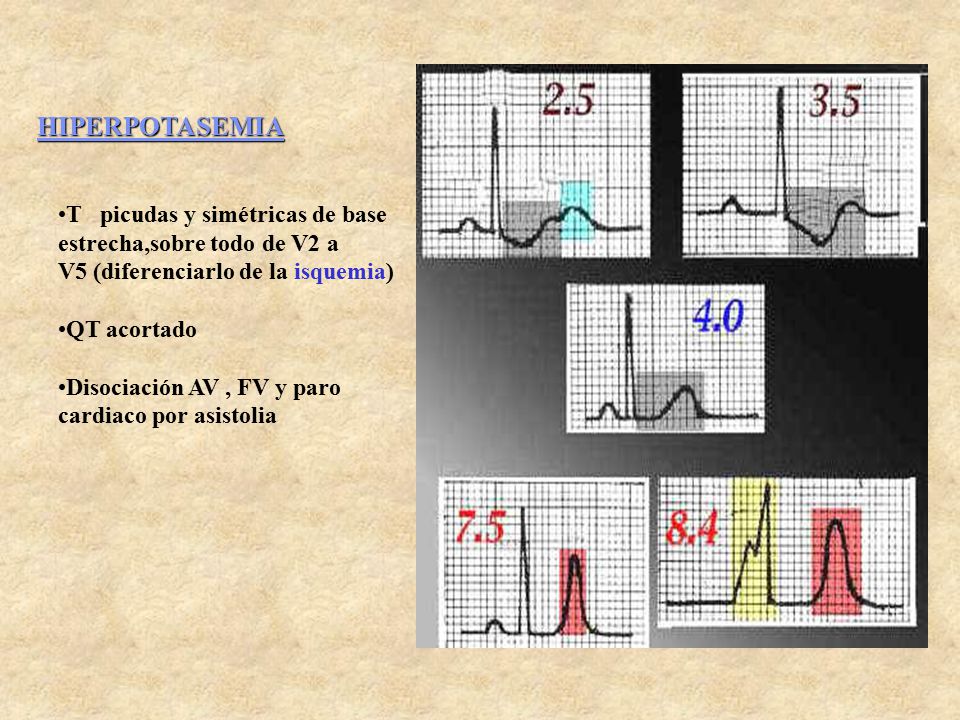 HIPERPOTASEMIA T picudas y simétricas de base estrecha,sobre todo de V2 a V5 (diferenciarlo de la isquemia)