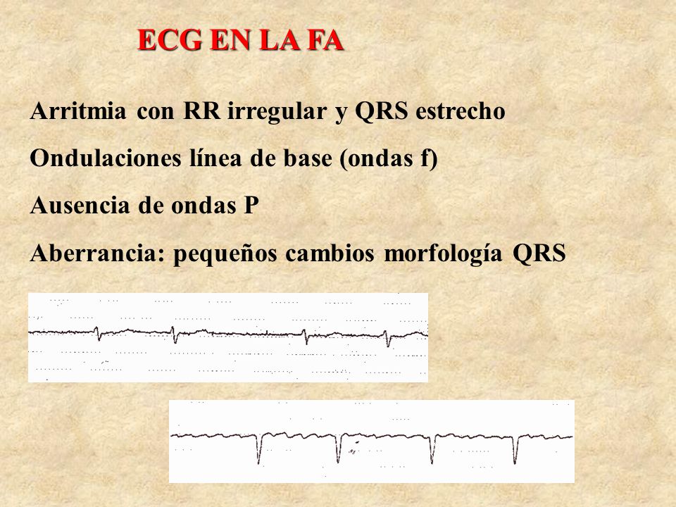 ECG EN LA FA Arritmia con RR irregular y QRS estrecho