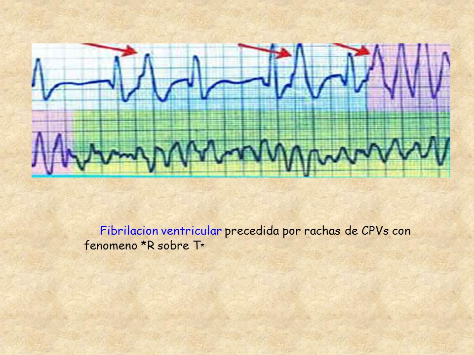 Fibrilacion ventricular precedida por rachas de CPVs con fenomeno