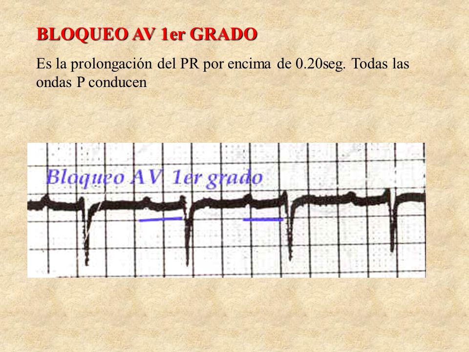 BLOQUEO AV 1er GRADO Es la prolongación del PR por encima de 0.20seg. Todas las ondas P conducen