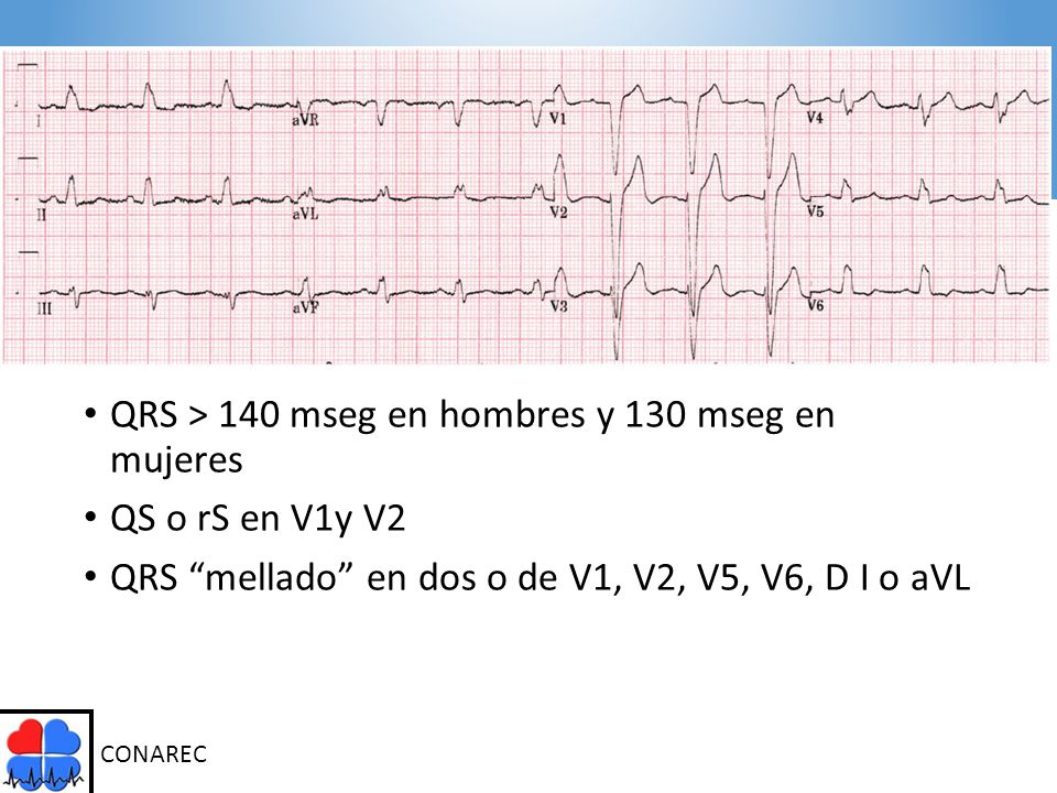 QRS > 140 mseg en hombres y 130 mseg en mujeres QS o rS en V1y V2