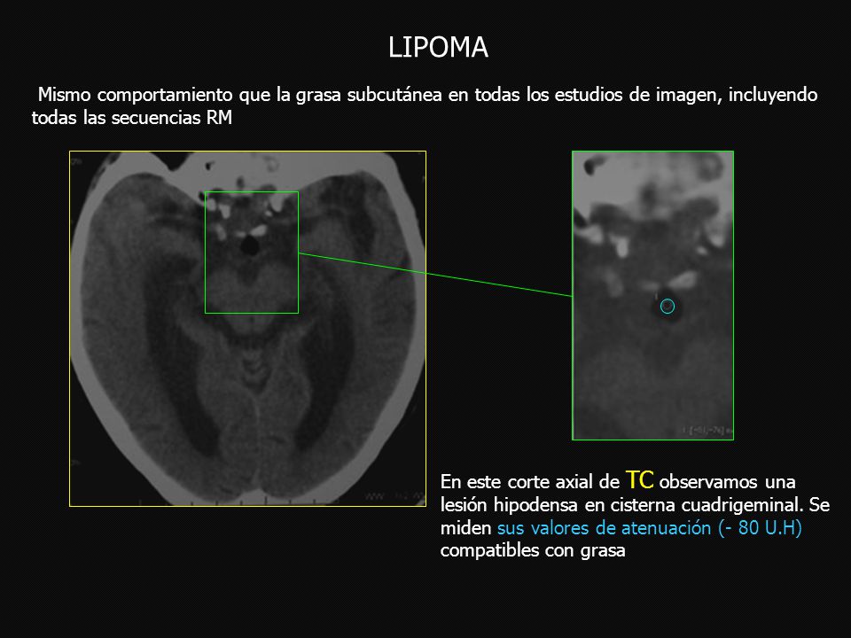LIPOMA Mismo comportamiento que la grasa subcutánea en todas los estudios de imagen, incluyendo todas las secuencias RM.