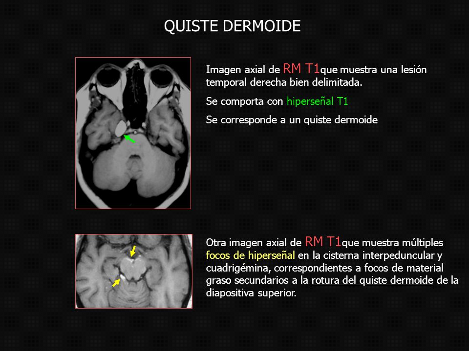 QUISTE DERMOIDE Imagen axial de RM T1que muestra una lesión temporal derecha bien delimitada. Se comporta con hiperseñal T1.
