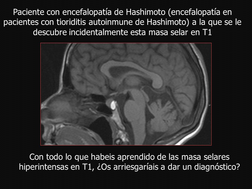 Paciente con encefalopatía de Hashimoto (encefalopatía en pacientes con tioriditis autoinmune de Hashimoto) a la que se le descubre incidentalmente esta masa selar en T1
