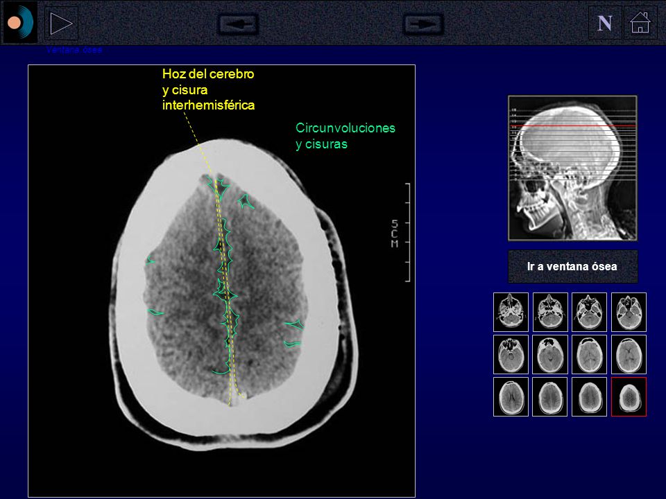 N Hoz del cerebro y cisura interhemisférica Circunvoluciones y cisuras