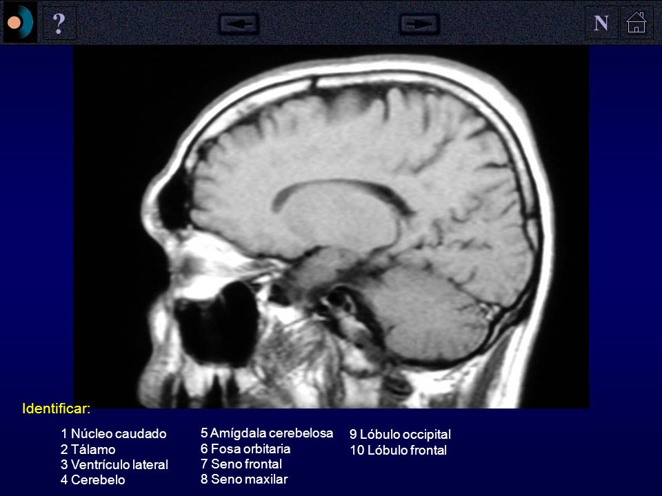 N Identificar: 1 Núcleo caudado 2 Tálamo 3 Ventrículo lateral