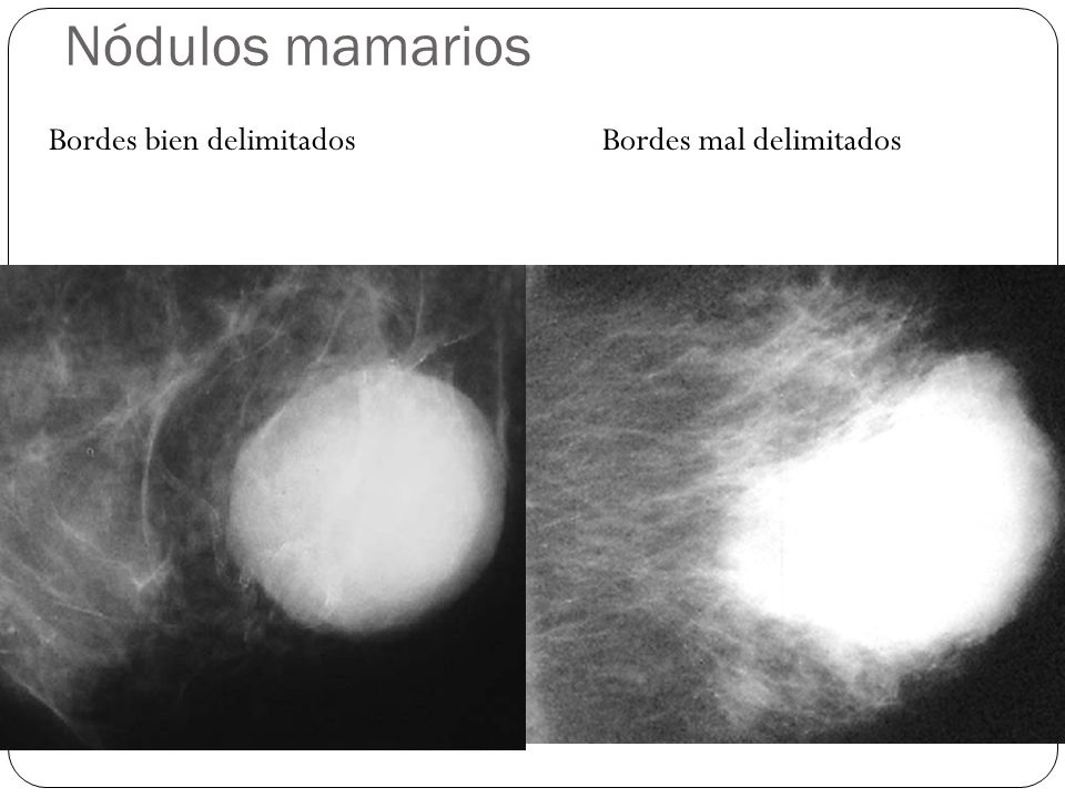 Nódulos mamarios Bordes bien delimitados Bordes mal delimitados