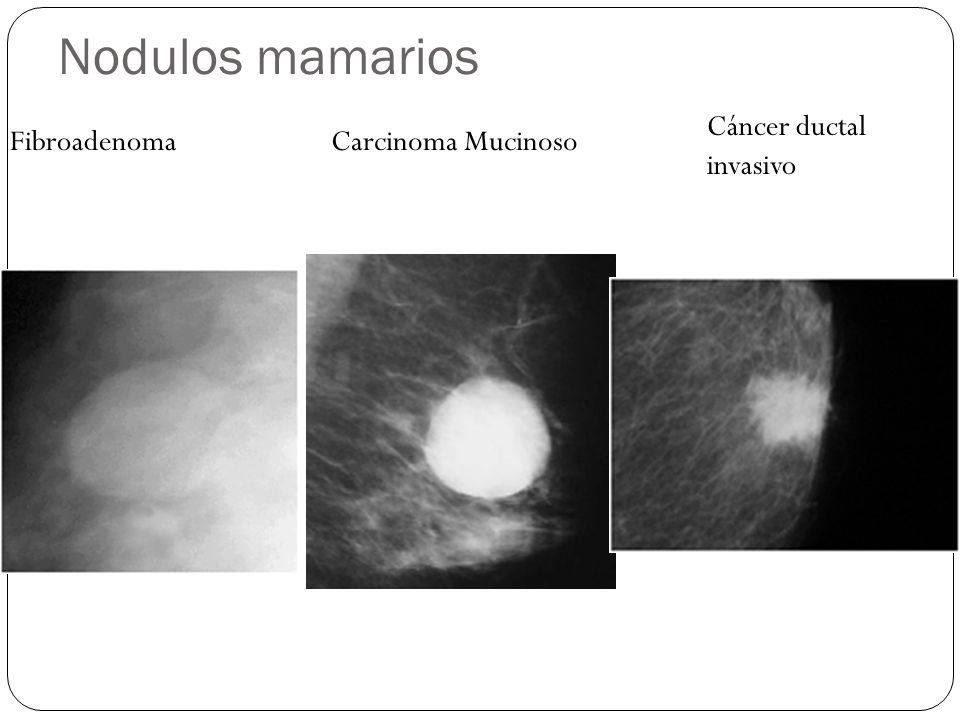 Nodulos mamarios Cáncer ductal invasivo Fibroadenoma