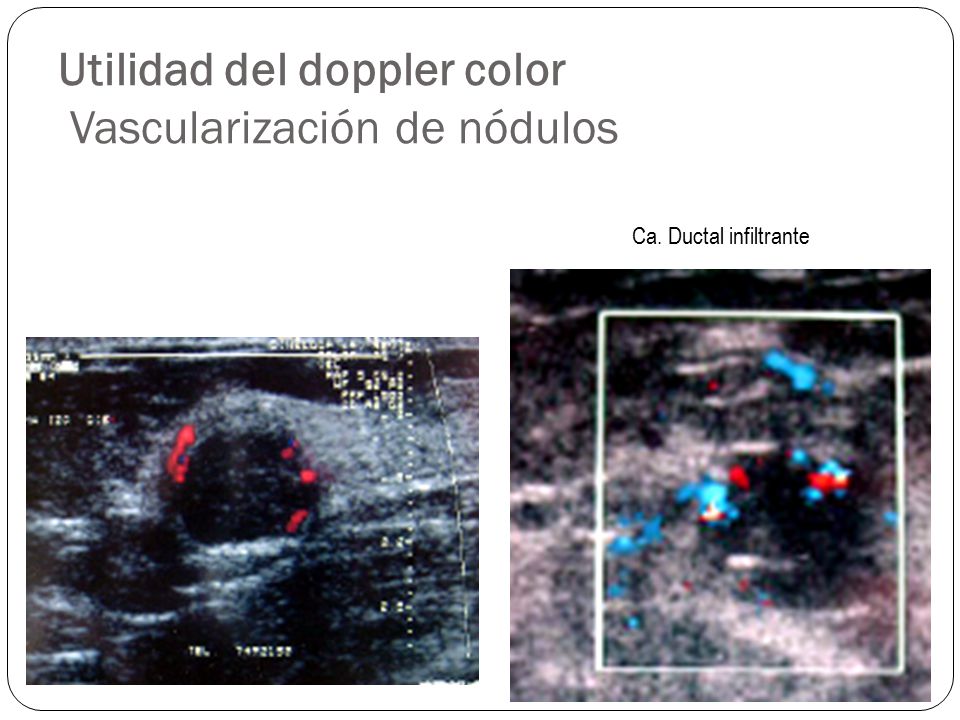 Utilidad del doppler color Vascularización de nódulos