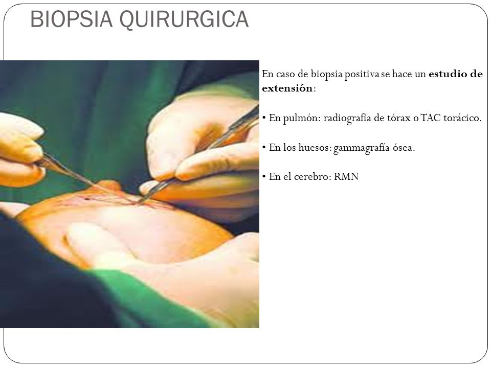 BIOPSIA QUIRURGICA En caso de biopsia positiva se hace un estudio de extensión: • En pulmón: radiografía de tórax o TAC torácico.
