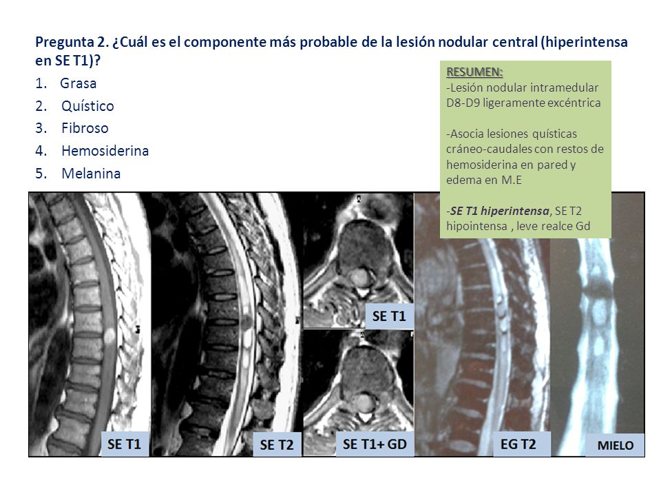 Pregunta 2. ¿Cuál es el componente más probable de la lesión nodular central (hiperintensa en SE T1)