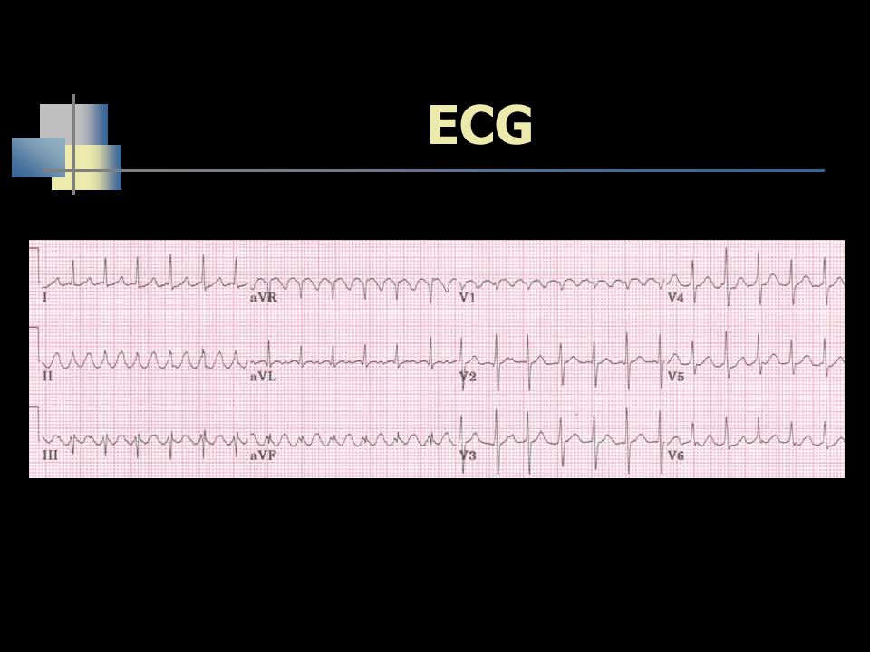 ECG