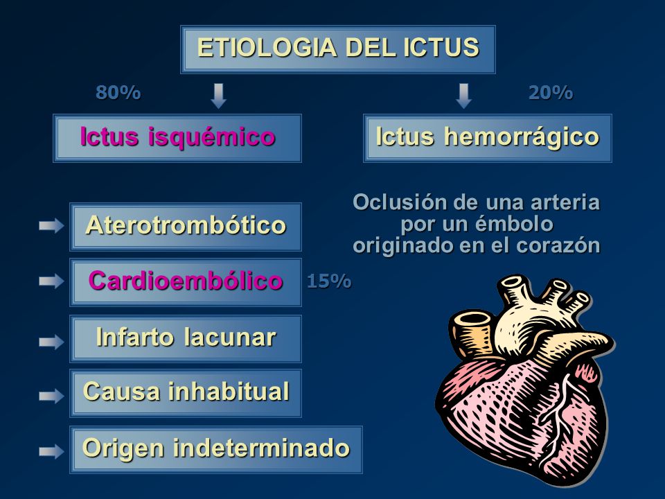 Oclusión de una arteria por un émbolo originado en el corazón