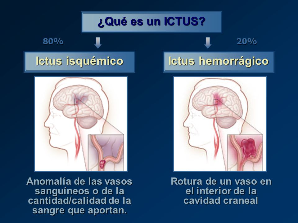 Rotura de un vaso en el interior de la cavidad craneal