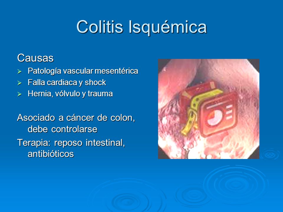 Colitis Isquémica Causas Asociado a cáncer de colon, debe controlarse