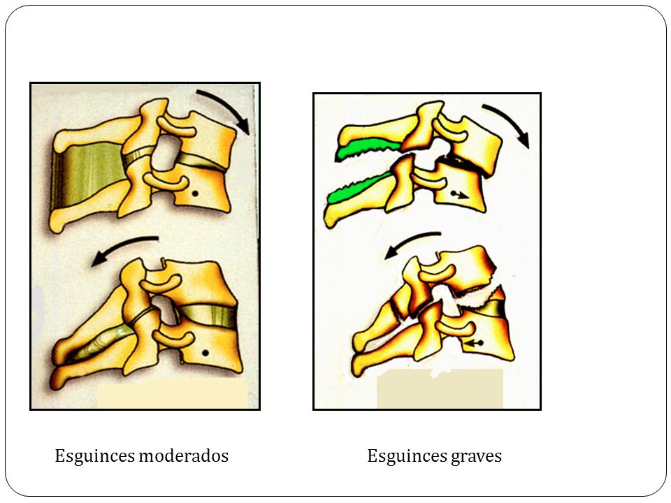 Esguinces moderados Esguinces graves