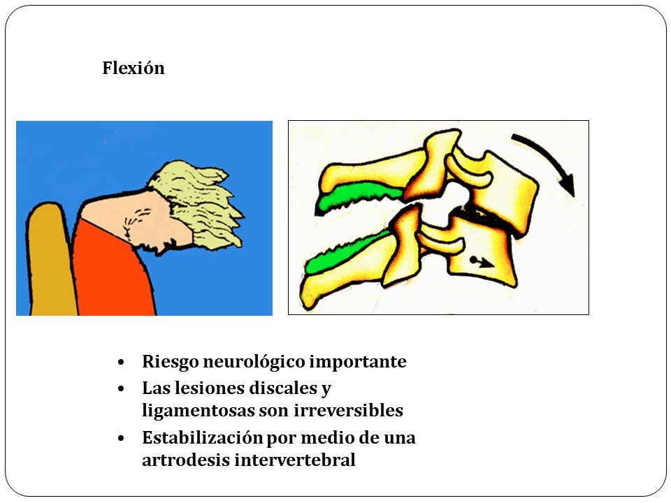 Flexión Riesgo neurológico importante. Las lesiones discales y ligamentosas son irreversibles.