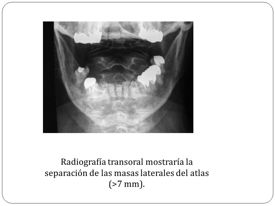 Radiografía transoral mostraría la separación de las masas laterales del atlas (>7 mm).