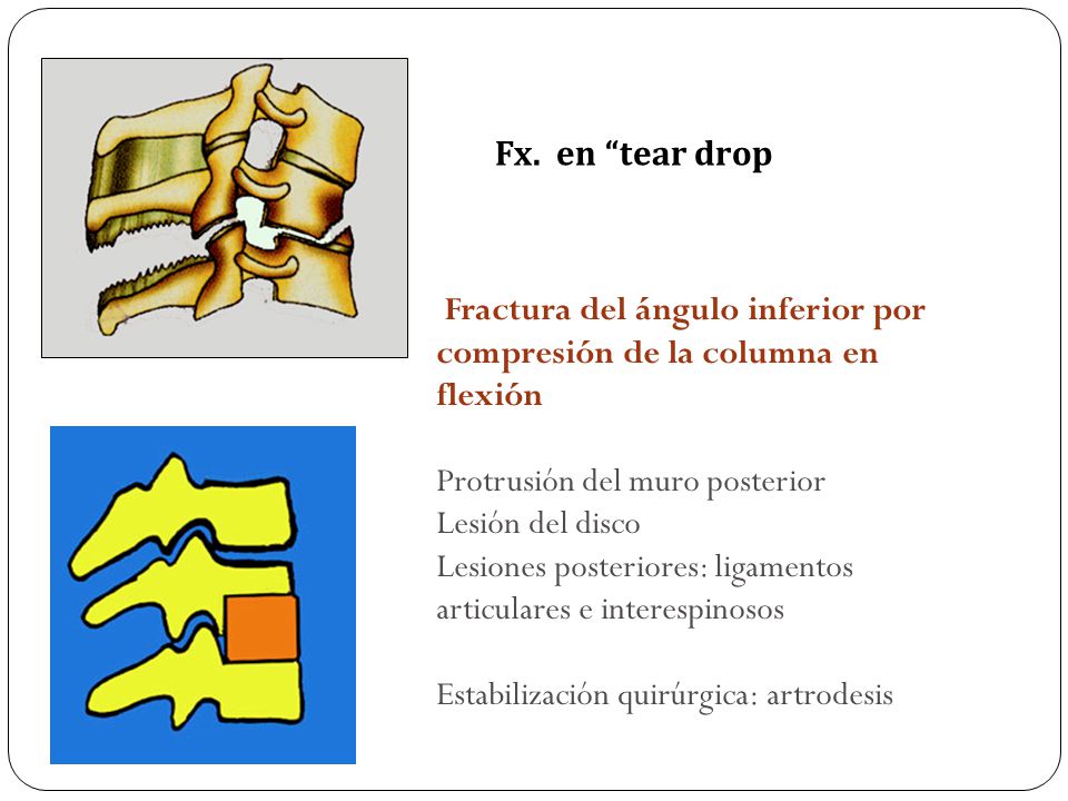 Fx. en tear drop Fractura del ángulo inferior por compresión de la columna en flexión. Protrusión del muro posterior.