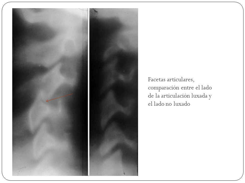 Facetas articulares, comparación entre el lado de la articulación luxada y el lado no luxado
