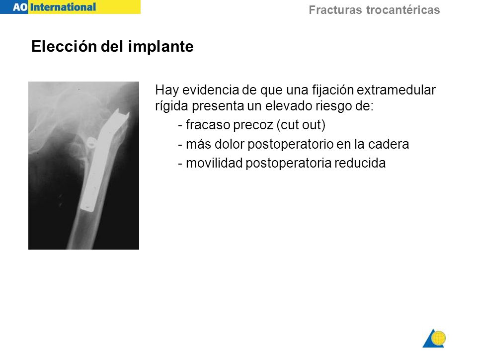 Elección del implante Hay evidencia de que una fijación extramedular rígida presenta un elevado riesgo de: