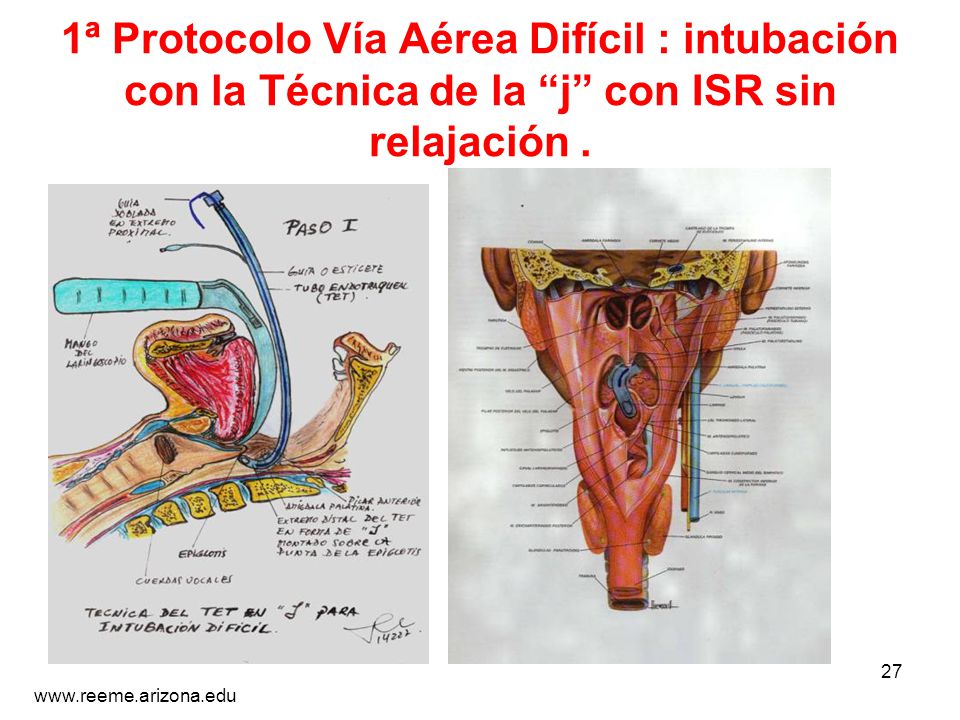 1ª Protocolo Vía Aérea Difícil : intubación con la Técnica de la j con ISR sin relajación .