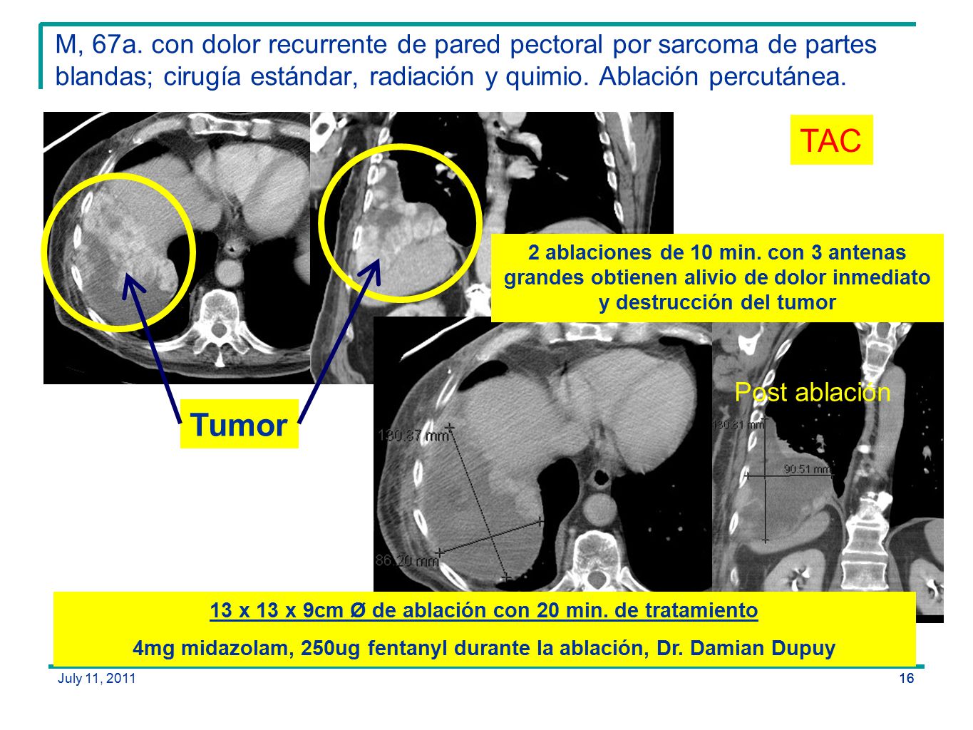 M, 67a. con dolor recurrente de pared pectoral por sarcoma de partes blandas; cirugía estándar, radiación y quimio. Ablación percutánea.