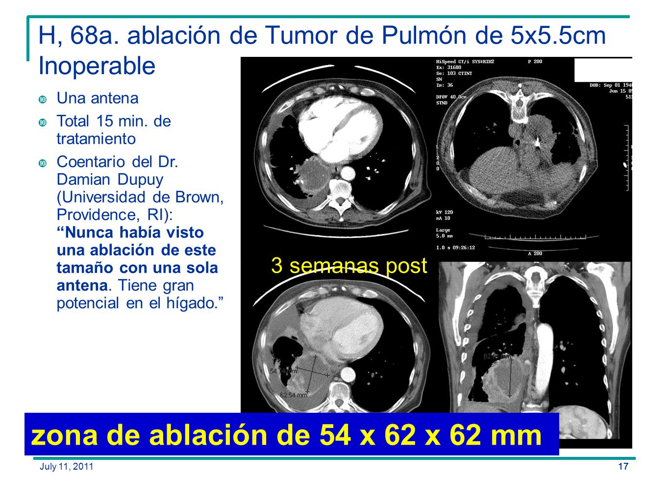 H, 68a. ablación de Tumor de Pulmón de 5x5.5cm Inoperable