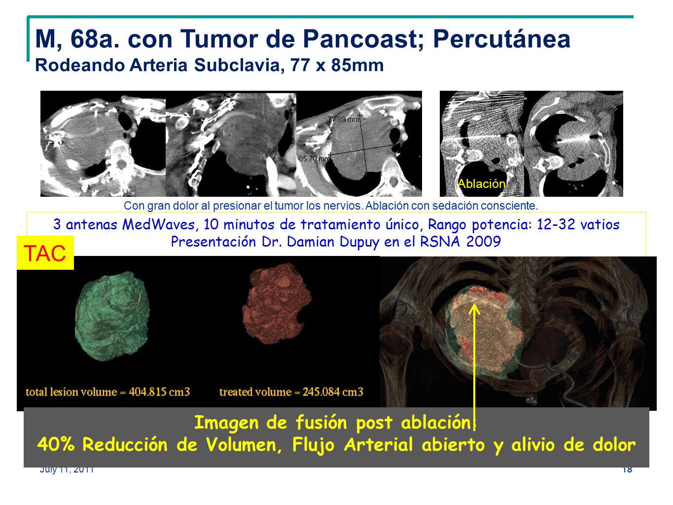M, 68a. con Tumor de Pancoast; Percutánea Rodeando Arteria Subclavia, 77 x 85mm