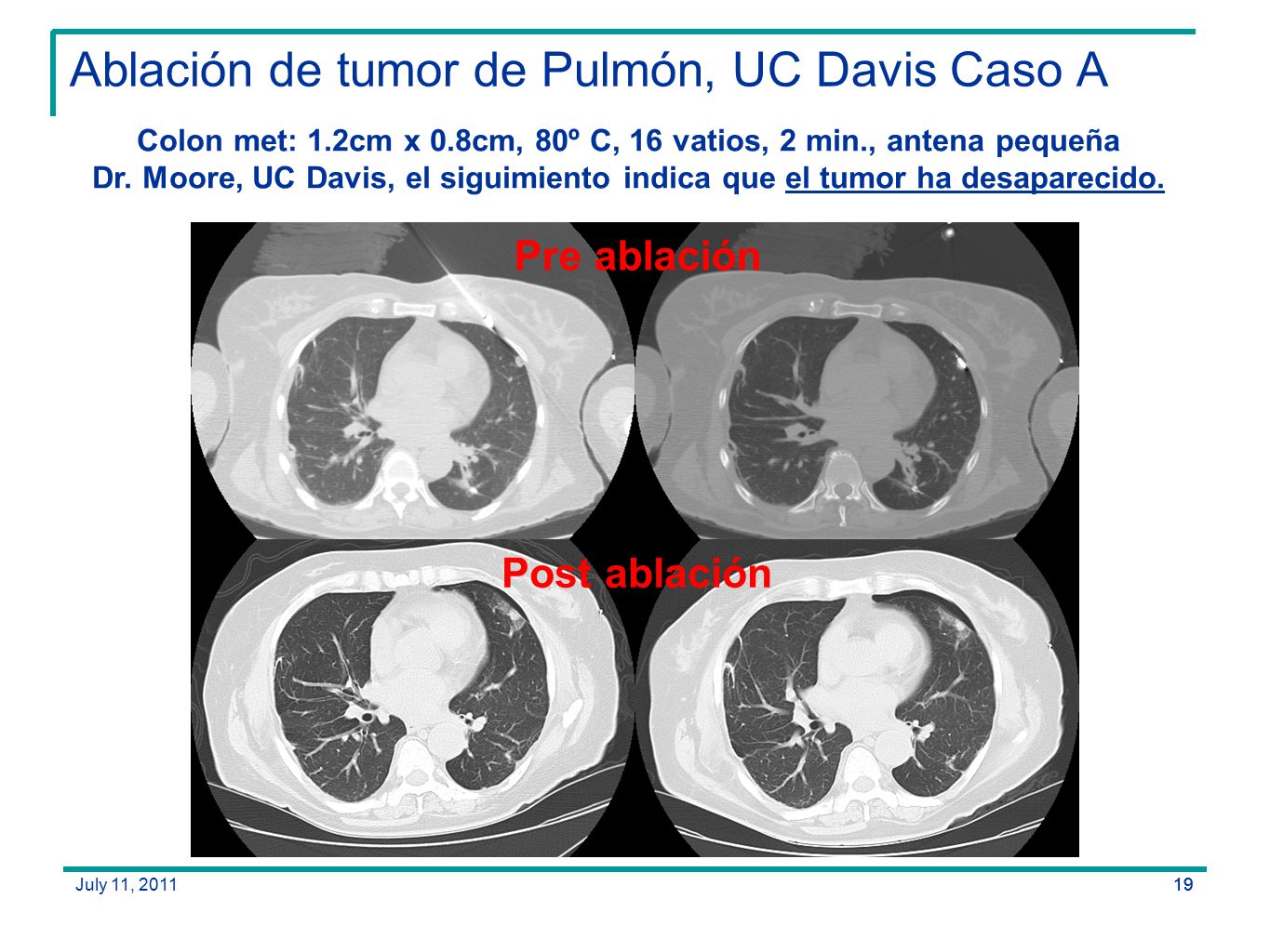 Ablación de tumor de Pulmón, UC Davis Caso A