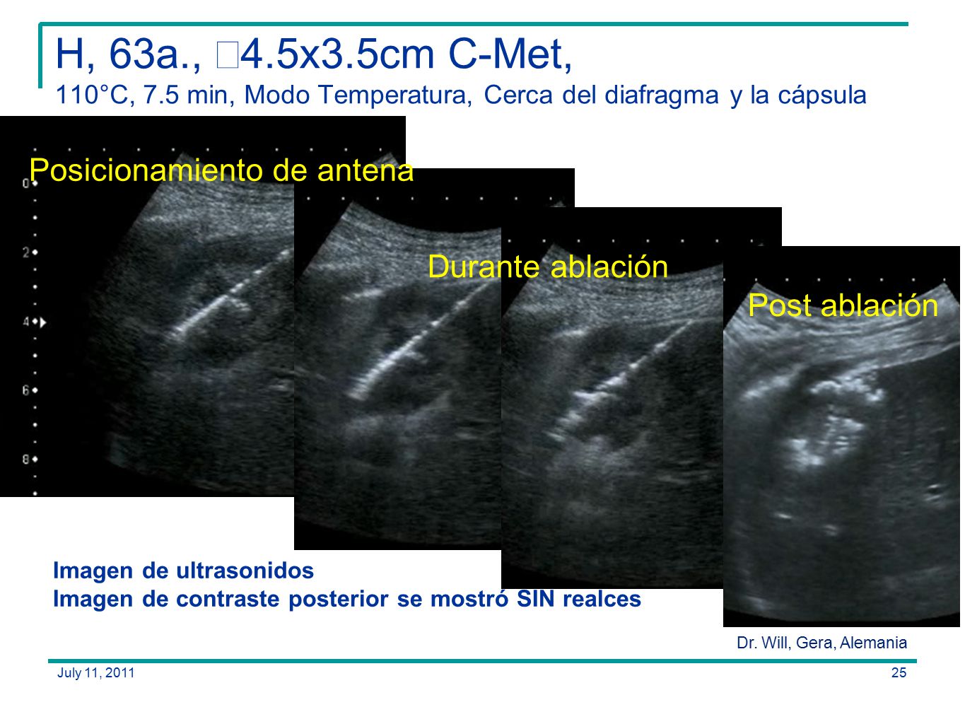 H, 63a., ∼4.5x3.5cm C-Met, 110°C, 7.5 min, Modo Temperatura, Cerca del diafragma y la cápsula