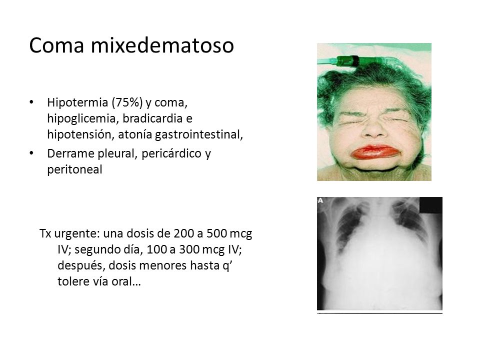 Coma mixedematoso Hipotermia (75%) y coma, hipoglicemia, bradicardia e hipotensión, atonía gastrointestinal,