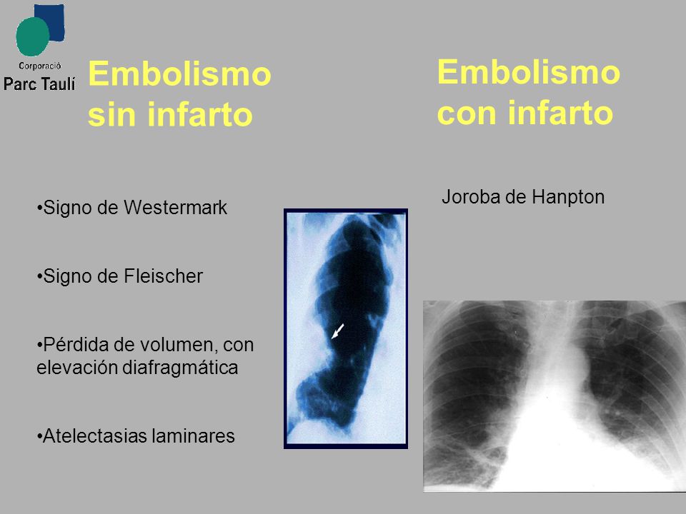 Embolismo sin infarto Embolismo con infarto Joroba de Hanpton